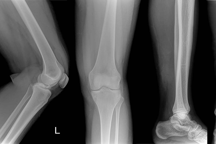 Defective Hip, Knee, Ankle Implants