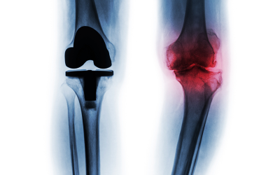 Defective Hip, Knee, and Ankle Implants